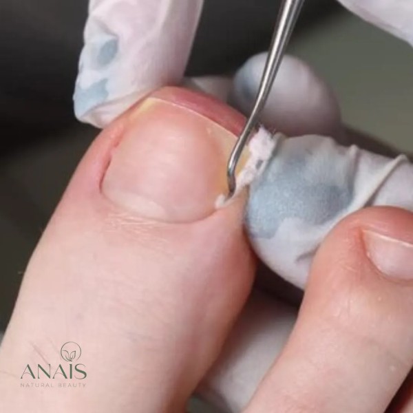 ANAIS – ONYCHOCRYPTOSE TRAITEMENT DE L’ONGLE INCARNE