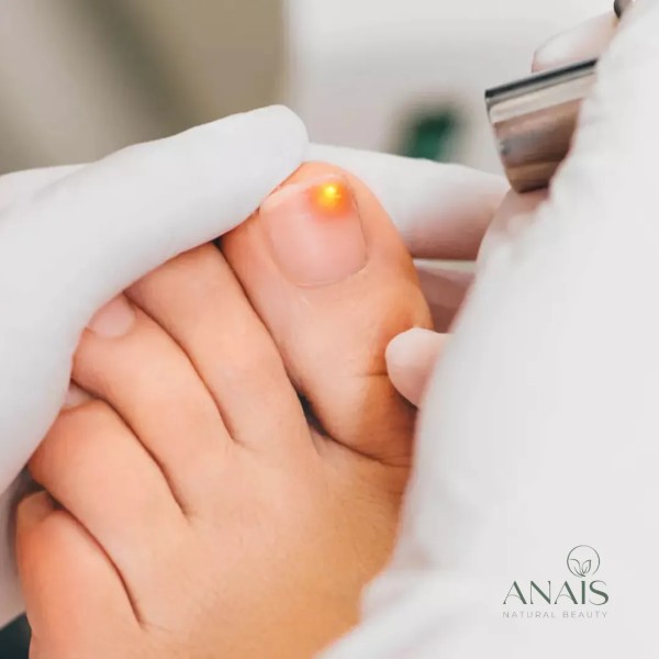 ANAIS – LASER ONYCHOMYCOSE (TRAITEMENT DES MYCOSES DE L’ONGLE)