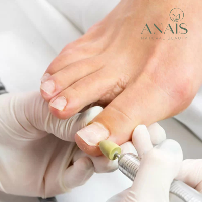 ANAIS – ONYCHOPLASTIE