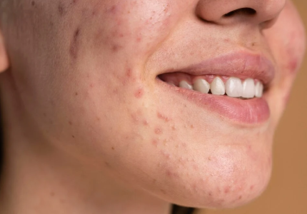 Acné, Les bons gestes au quotidien pour une peau nette et saine