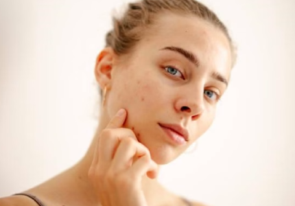 Crèmes solaires et imperfections : comment vous protéger sans aggraver votre peau ?