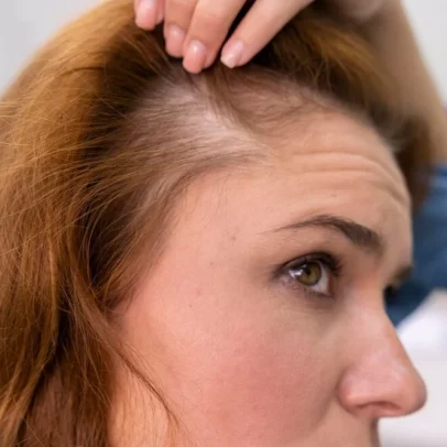 chute de cheveux