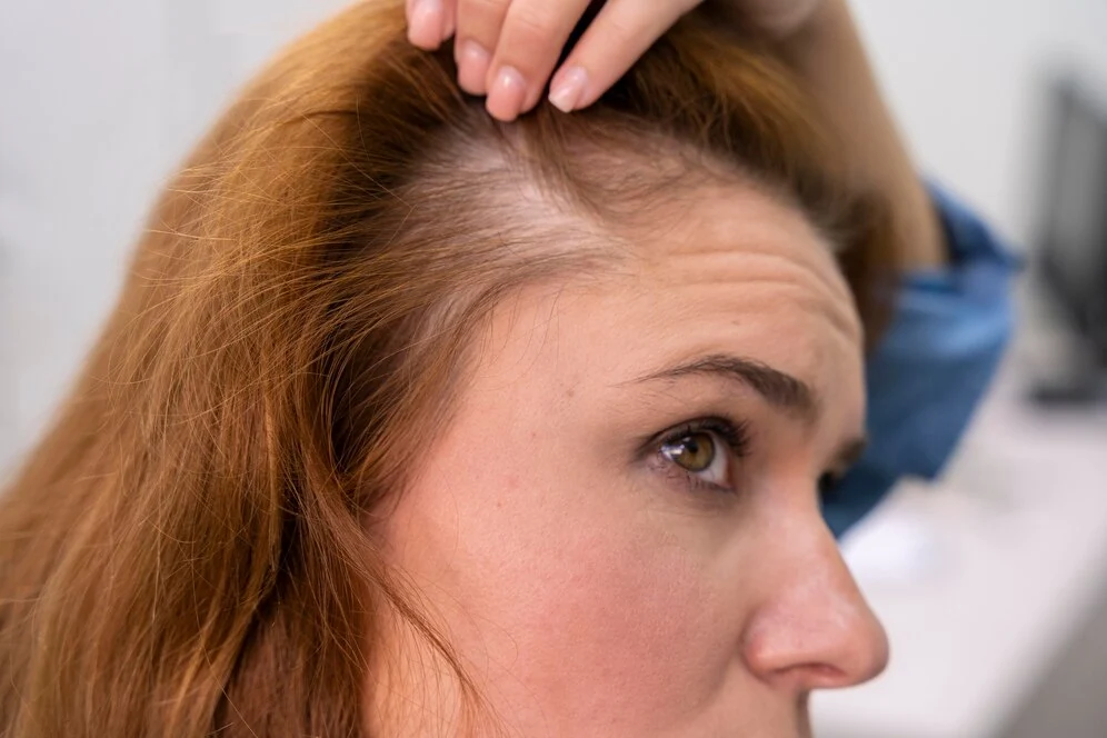 chute de cheveux